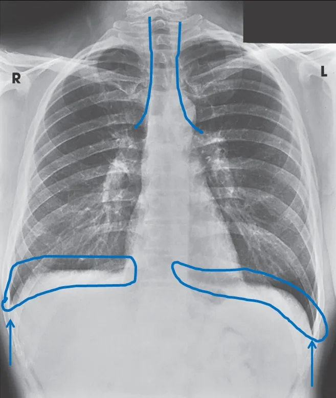 Radiographie thoracique montrant la cage thoracique et les poumons